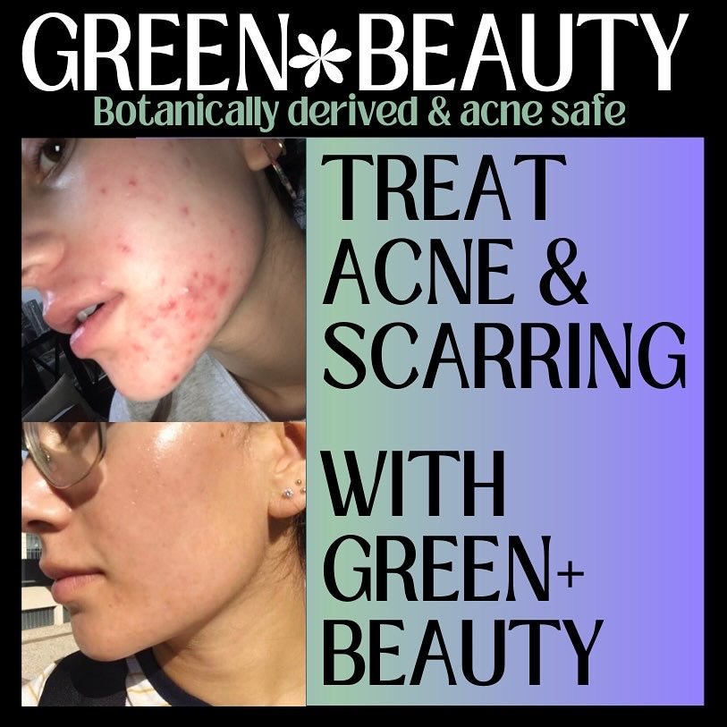 Acne Clearing Spot Treatment - Green + Beauty Skincare